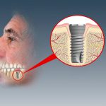 Schematisk teckning av applicerat implantat. Till detta skruvas sedan en individuellt framställd tandkrona